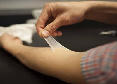 محققان پوست مصنوعی برای الیتام زخم تولید کردند