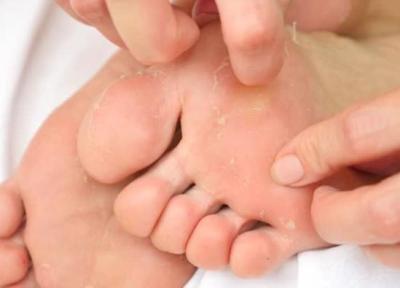 5 علت رایج پوسته پوسته شدن کف پا
